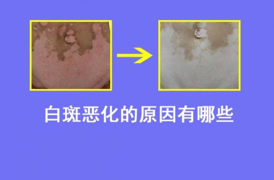 白癜风医生林华：导致白癜风病情恶化的原因有哪些
