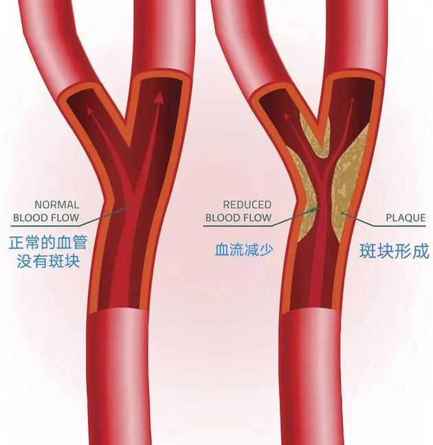 明医方中医药治疗颈动脉斑块【三剂疗法】