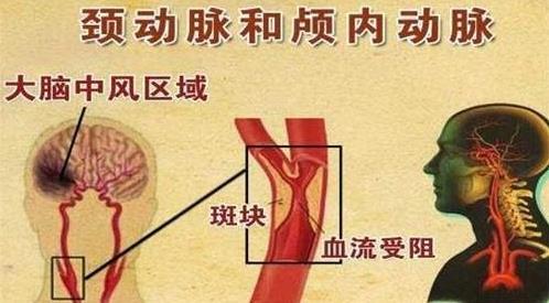 明医方中医药治疗颈动脉斑块【三剂疗法】