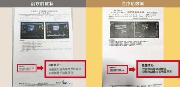 明医方中医药治疗颈动脉斑块【三剂疗法】