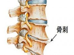 什么叫骨质增生？骨质增生要注意什么事项