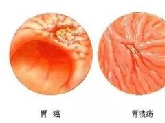 广东民安医院收费合理别老是把慢性胃炎当急性不理会，久拖不治出大事！