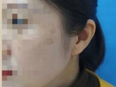 花还开科技祛斑：熬夜长老年斑只是谣言？！