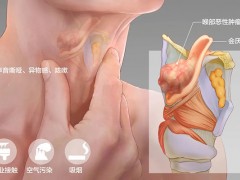 成都民生耳鼻喉医院科普 声音嘶哑是什么病