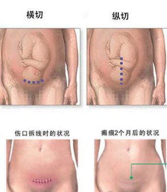 剖腹产二胎和一胎的刀口在同一位置吗？剖腹产生二胎刀口怎么开