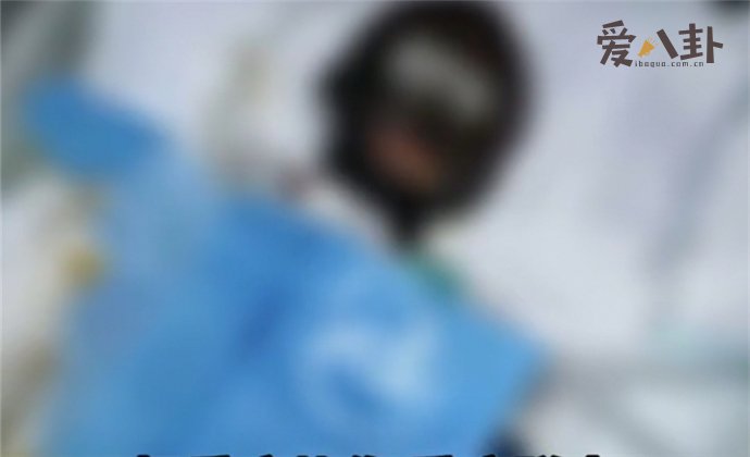 网红拉姆个人资料 直播时被前夫烧伤伤情令人担忧