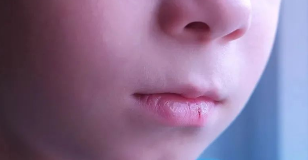 为什么一到秋天嘴唇就起皮？润唇膏用得越多越好吗？