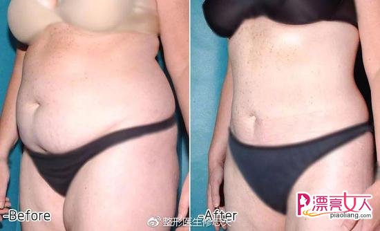 号称不会反弹的吸脂减肥为何做完还会发胖