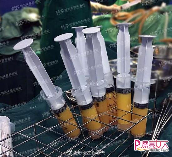 号称不会反弹的吸脂减肥为何做完还会发胖