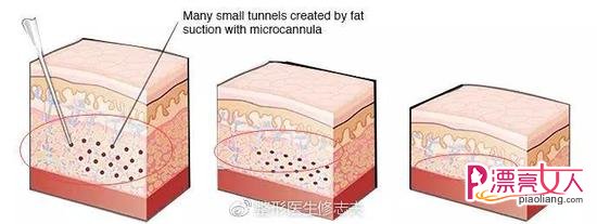 号称不会反弹的吸脂减肥为何做完还会发胖