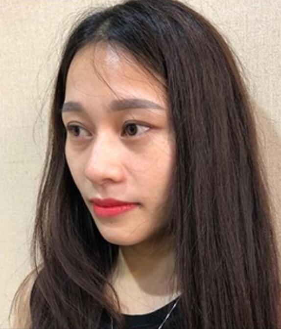 灵旋笔记：眼袋过重，就会显得比真实年龄大，要如何修复眼袋呢?