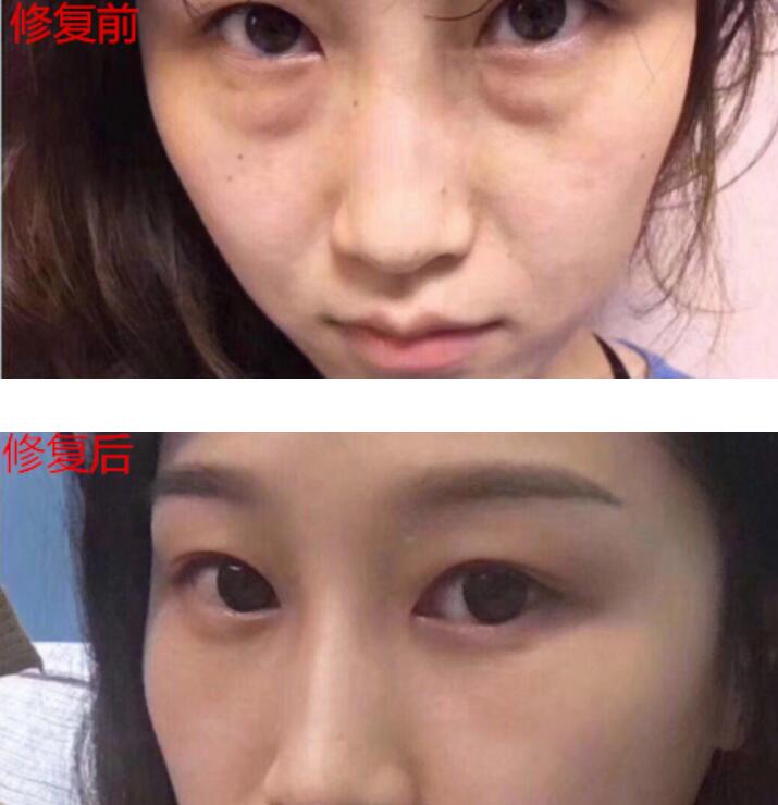 灵旋笔记：眼袋过重，就会显得比真实年龄大，要如何修复眼袋呢?
