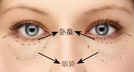 卧蚕和眼袋的区别 两者的区别可大着呢