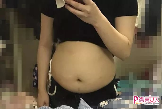 吸脂瘦腹成功案例分享 大肚妹子有小蛮腰了