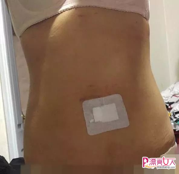 吸脂瘦腹成功案例分享 大肚妹子有小蛮腰了