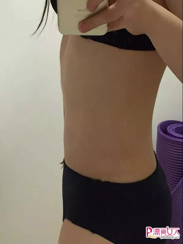 吸脂瘦腹成功案例分享 大肚妹子有小蛮腰了