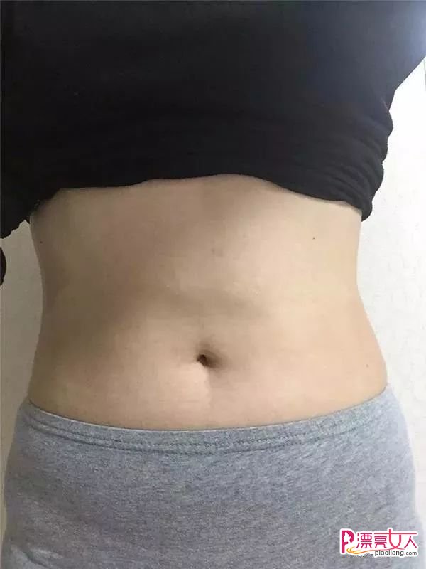 吸脂瘦腹成功案例分享 大肚妹子有小蛮腰了