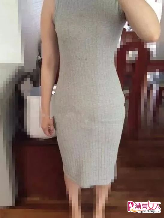 吸脂瘦腹成功案例分享 大肚妹子有小蛮腰了