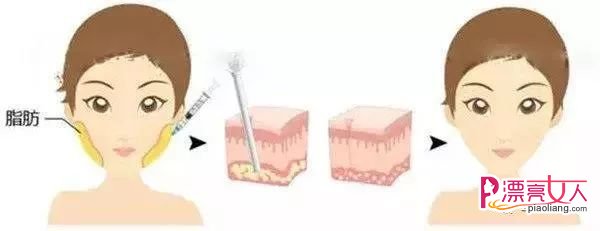 瘦脸针和溶脂针哪个好 溶脂针和瘦脸针的区别