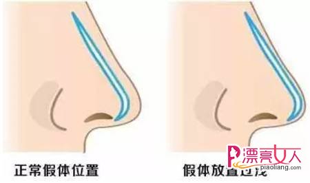 隆鼻有后遗症吗 隆过鼻子老了之后会怎样