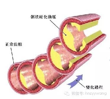 三高人群最易动脉硬化 动脉硬化可以没症状