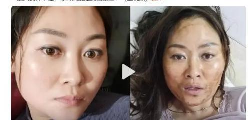 女子感染新冠高烧后满脸发黑