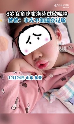 啊！这么严重！8岁女孩吃布洛芬过敏肿成香肠嘴