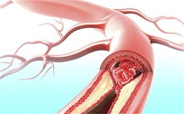 血管堵塞老化怎么办